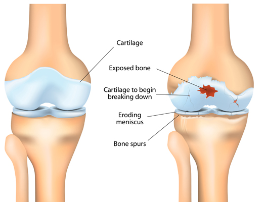 A jobb bokaízület deformáló artrózisa, Ha a lábujjak ízületei fájnak